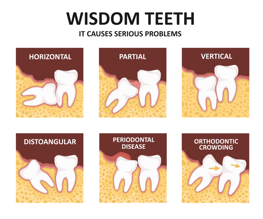 How Long For Wisdom Teeth Removal Pain Tutorial Pics